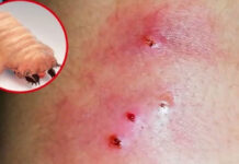 Confirman autoridades primeros 2 casos de miasis en humanos por gusano barrenador en Oaxaca