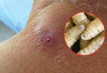 Tras primera muerte contabilizada, hallan en Oaxaca nuevo caso de miasis humana por gusano barrenador