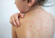 Contabilizan en Oaxaca 28 casos confirmados de sarampión y 117 casos probables; Mixteca, la región más afectada